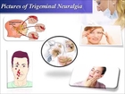 Trigeminal Neuralgia - Causes, Symptoms, Prevention and Treatment - Biogetica